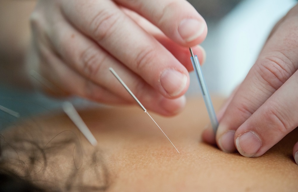 Dry Needling  Sanger, TX